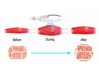 30min abdomen treatment = 20000 sit-ups
