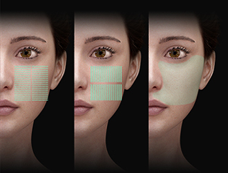 Multimodal care
Micro-pulses achieve the superposition of tiny and precise thermal coagulation points, acting evenly and densely on all areas of the target layer, and densely dispersed energy has a relatively wider effect, highlighting the overall advantage.