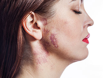 Melanin absorbs laser energy to break up melanin particles，clearing spots without harming the skin