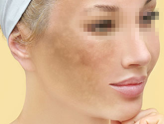 Treatment process is shortened from the original 10 times to 2-3times