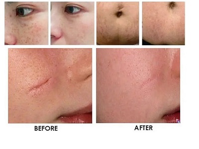 CO2 Fractional Laser Machine