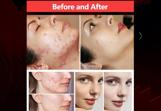 Picosecond Treatment: Before and After