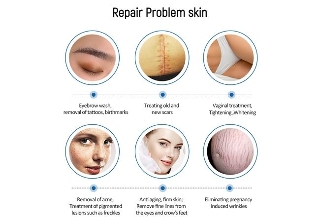 Picosecond Treatment: Before and After